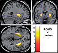 PET scan