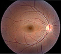 Retinal photograph