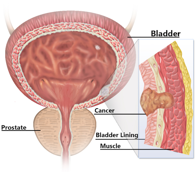 Bladder diagram