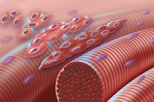 Normal myoblasts (early muscle cells with a single nucleus) fuse together to form myocytes (multinucleated muscle cells) during myogenesis. In Carey-Fineman-Ziter syndrome, this cascade is disrupted because of a defect in the membrane protein, myomaker, which is required for cell-cell fusion. Credit: Darryl Leja, NHGRI.