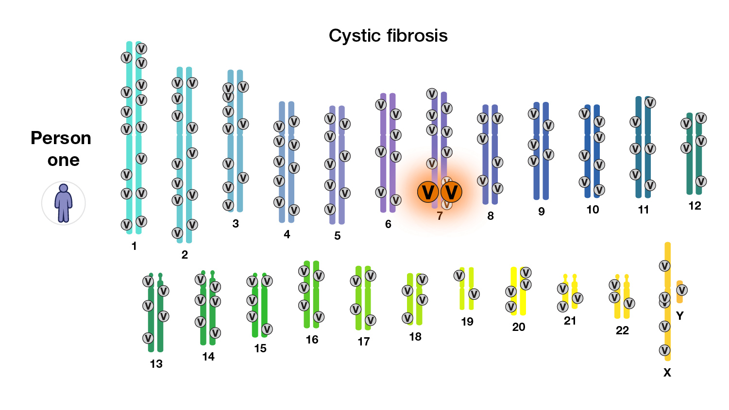 Person one, cystic fibrosis