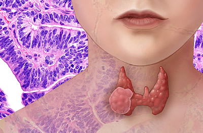 Thyroid