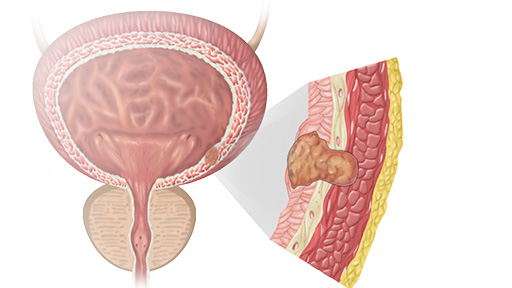 Bladder Cancer