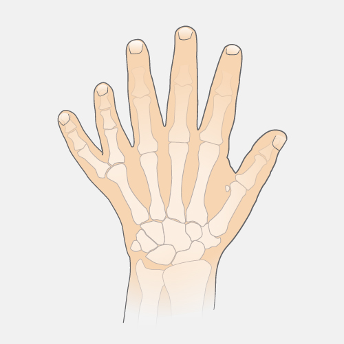 Polydactyly_dyn